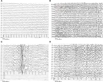 A Patient With CAD Deficiency Responsive to Uridine and Literature Review